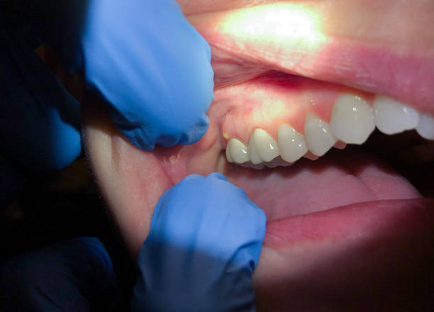 Best Emergency Dental Extractions in Caddo, OK